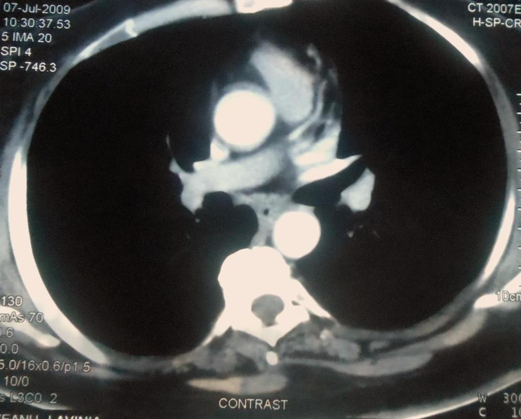 abdominal CT scan: rules out massive PE and identifies the cause of hemodynamic