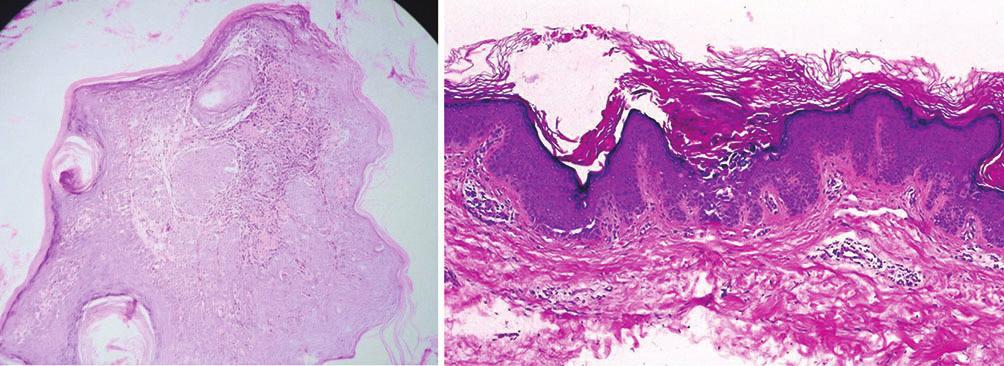Epidermal patterns (1) Epidermal changes in psoriasis Most common histopathologic findings in psoriasis seen in present study were acanthosis(84.6%), hyperkeratosis(76.9%), parakeratosis(69.