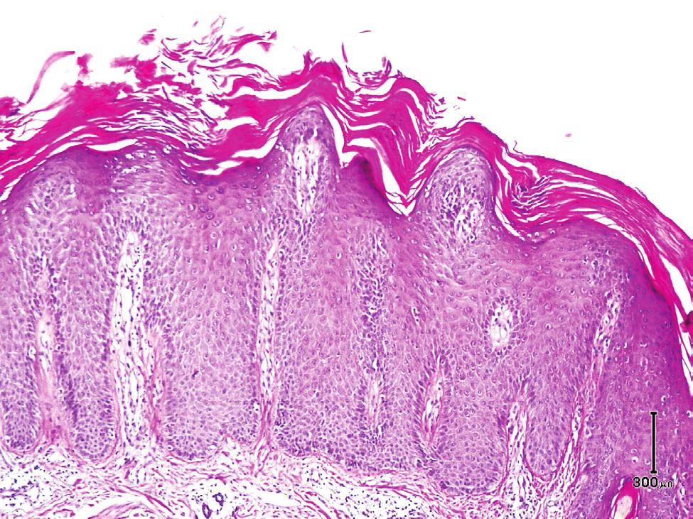 Neutrophilic infiltration in dermis, papillary dermal edema, mitosis in basal layer, pseudolipomatous changes and RBC s extravasation were seen more in psoriasis.