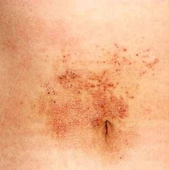 Subacute dermatitis by metal : scaly