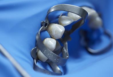 restoration fast and easy by replacing dentin and enamel.
