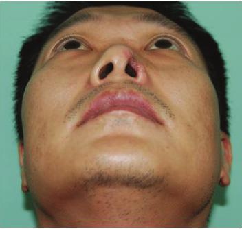 Case 1 A 43-year-old man was referred to our plastic surgery unit due to a human bite. On examination, the patient exhibited a definite defect (approximately 1 0.