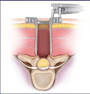 Approach Midline spinal incision Muscle Retraction Wide exposure of tumor Minimally Invasive (Tubular) and Mini-open