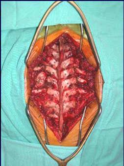 cervicothoracic or TL jxn May add fusion to prevent kyphosis Traditional Approach: Intradural Spinal Tumor +