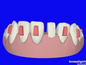 Lower Incisor  to