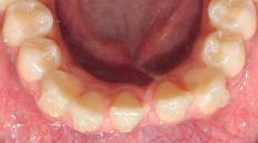 Lower Incisor Extraction Case Start to Finish
