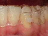 Must wear aligners after surgery to prevent