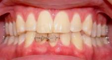 Lower Incisor Extraction: In the Beginning Before