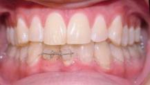 Braces RM:Md:27 19 The first cases.