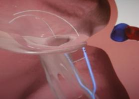 Amend* Micardia encor Cardiac Implants RDS