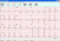 Continuous ECG recording Definition of the optimal time of extraction