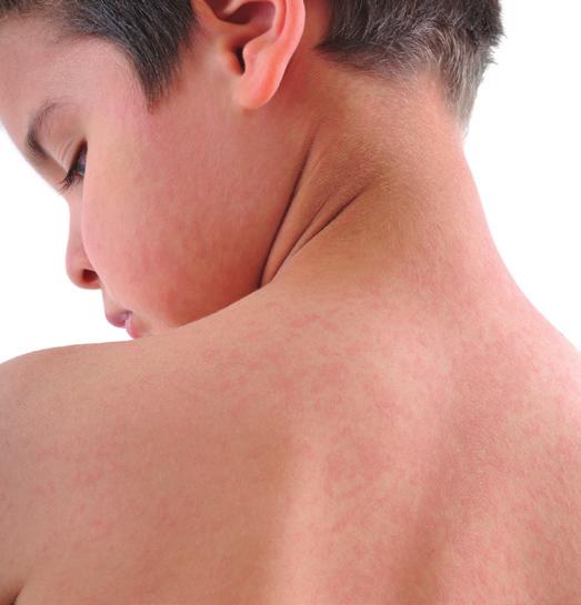 What is Urticaria Do you suffer from raised rashes or patches?