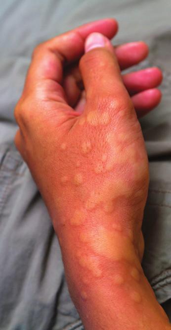 Physical Urticaria Dermagraphism is raised welts or wheals caused by direct pressure on the skin. It can be demonstrated by writing on the skin with a pointed object.
