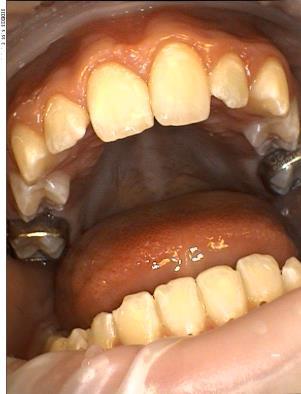 period with a splint activator and had returned to the practice for a two week recall, we bonded the brackets (image 1-6) on the 15 August of this year (2011).