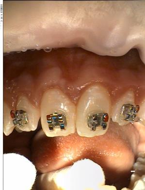 The Optra Gate (extrasoft-small, Ivoclar Vivadent) was inserted before any cementing or further steps were undertaken.