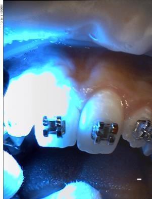 Before treating the surface of the teeth with a conditioner (GC Fuji Ortho Gel Conditioner), the tooth enamel was dried using compressed air.