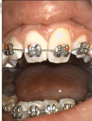 [8] Once the treatment is finished, the brackets can be removed with much less physical effort than with composite adhesive systems.