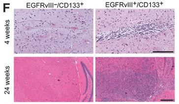 EGFRvIII: marker of Cancer stem cell EGFRvIII is highly