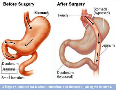 Roux-en en-y gastric bypass (RYGB) Restrictive and malabsorptive surgical procedure Provides large and Durable weight loss Well known to improve