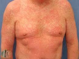 Rash Rash All TB meds can cause rash Minor: Manage symptomatically (ie antihistamine) Signs of more severe rash: Mucous membrane involvement suggests SJS/TEN Fever, CBC abnormalities (eosinophilia,