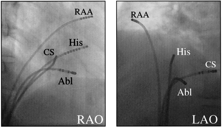 ow to ablate typical AVNRT 17 Figure 2 Catheter positions during ablation of AVNRT. Radiographs taken in the right and left anterior oblique views are shown (RAO & LAO).
