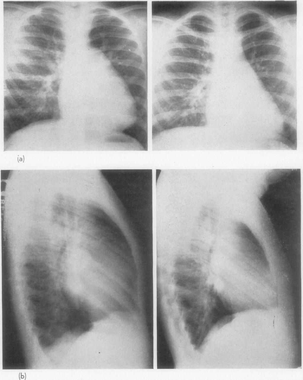 42 A. R. C. Dobell, D. R. Murphy, G. M. Karn, and A. Martinez-Caro allm1 -R.08, Thorax: first published as 10.1136/thx.20.1.40 on 1 January 1965. Downloaded from http://thorax.bmj.com/ FIG. 2.