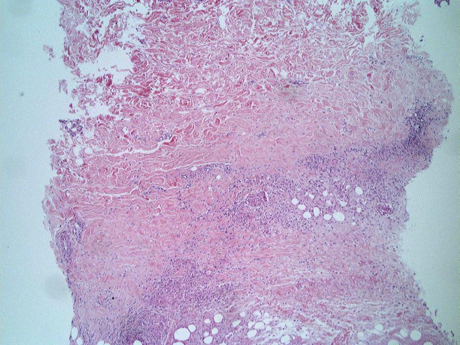 The patient had no history of trauma, insect bites, or topical use of drugs or cosmetics. Skin biopsy showed dermal necrosis and remarkable fat necrosis with lobular panniculitis.