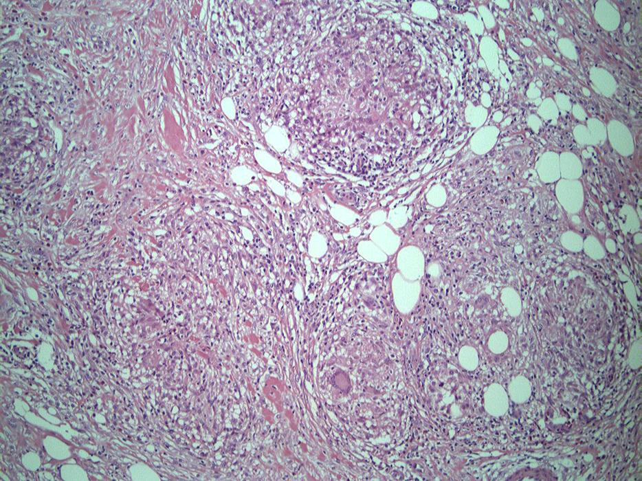 Multiple tender skin-colored to slightly erythematous round to oval subcutaneous nodules. Fig. 2. Granulomatous inflammation at the dermo-subcutaneous junction (H&E, 40).