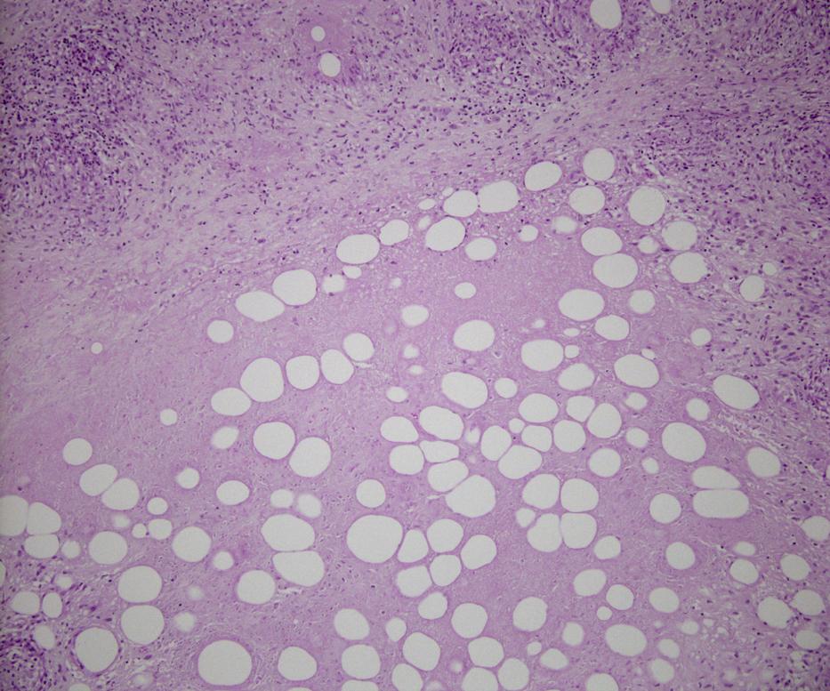 Diastase-treated periodic acid-schiff (PAS) stain was negative and Ziehl-Neelsen stain failed to reveal acid-fast bacilli.