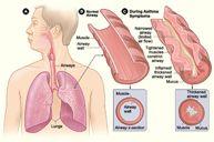 Inhaled corticosteroids (ICS)! Most potent and consistently effective long-term control medication for treatment of asthma! Work on Airway inflammation through a variety of mechanisms!
