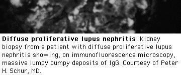 associated with SLE Lupus
