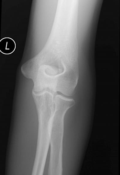 Figure 1 Figure 1: Plain X-ray of the elbow showing a defect in the distal humerus with a sclerotic rim.