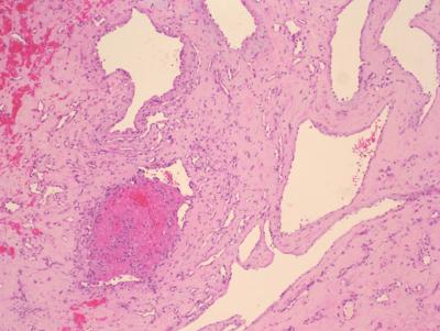 Histologically, the tumor was well circumscribed and composed of thin-walled vascular spaces underneath the synovial membrane.