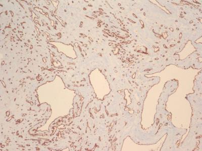 Figure 4 Figure 4: CD-31 special stain demonstrating strong reactivity of the lining endothelium (100X).