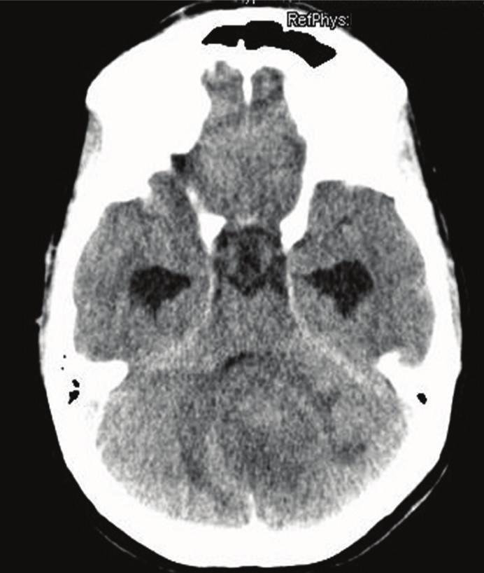 2 Case Reports in Pathology (a) (b) (c) (d) Figure 1: (a) CT-scan, after contrast administration, showing the cerebellar tumor, with peritumoral edema and hydrocephalus.