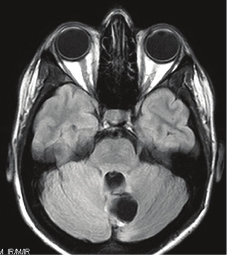 Areas of pilocytic astrocytoma, with Rosenthal fibers and eosinophilic granular bodies were occasionally identified. These areas showed strong gliofibrillary acidic protein (GFAP)-positivity.