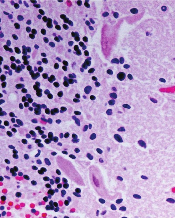 (d) Vessels with glomeruloid aspect among tumor cells (h