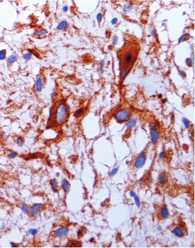 cells with normal aspect can be seen (h and e, 200).