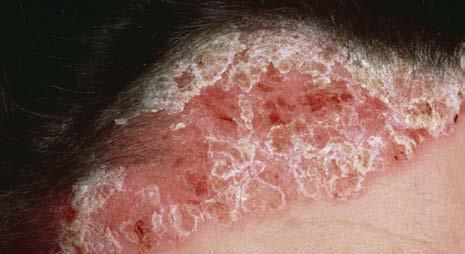 TYPES OF PSORIASIS WHAT TYPES OF PSORIASIS ARE THERE?