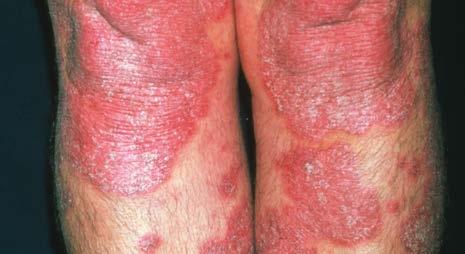 While the plaques can occur anywhere on the body, they normally appear on the elbows, knees, scalp and lower back. They can be itchy or sore or both. 3,4 DIAGNOSIS HOW IS PSORIASIS DIAGNOSED?