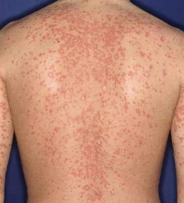 PASI (or Psoriasis Area and Severity Index) is a formal system used to measure the severity and extent of a person s psoriasis, before and after treatment.