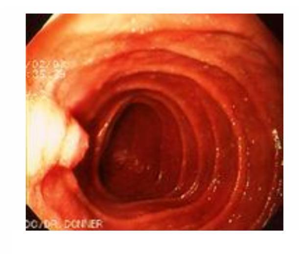 one of them has its sphincter. Sometimes the junction occurred before the sphincter of Oddi forming hepatopancreatic duct (one Duct).