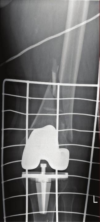 2 Case Reports in Orthopedics Figure 1: Preoperative AP X-rays showing bilateral symmetrical