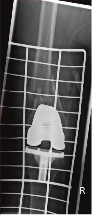 Figure 3: Immediate postoperative AP and lateral X-rays showing a left periprosthetic knee