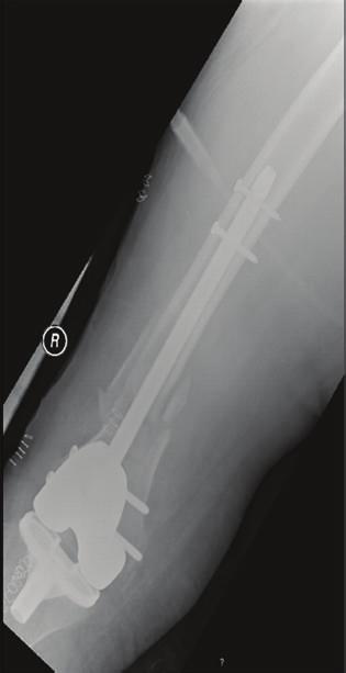 Figure 2: Immediate postoperative AP and lateral X-rays showing a right periprosthetic knee  a