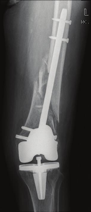 Five months after surgery (Figures 4 and 5), the patient was able to walk with crutches and