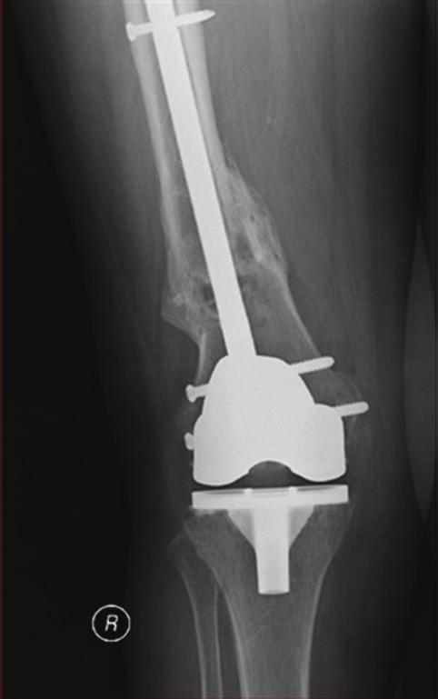 Figure 7: 24 months of postoperative AP and lateral left knee X-rays showing complete consolidation of the fracture.