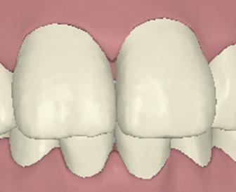 A single lower incisor extraction may be indicated for an adult patient where there is significantly more lower anterior crowding than upper crowding and the posterior occlusion is very tightly