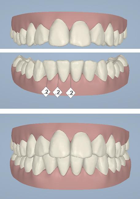 Crowding and teeth inclination When the patient presents with lingually tipped anterior and/or posterior teeth, arch length can be increased by proclination of the anterior teeth and expansion of the