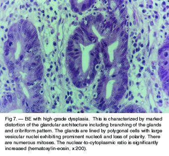 of dysplasia and subsequent biologic behavior of the lesion, and (3) inter- and intra-observer variation, especially when assessing intermediate grades of dysplasia (indefinite or low grade).